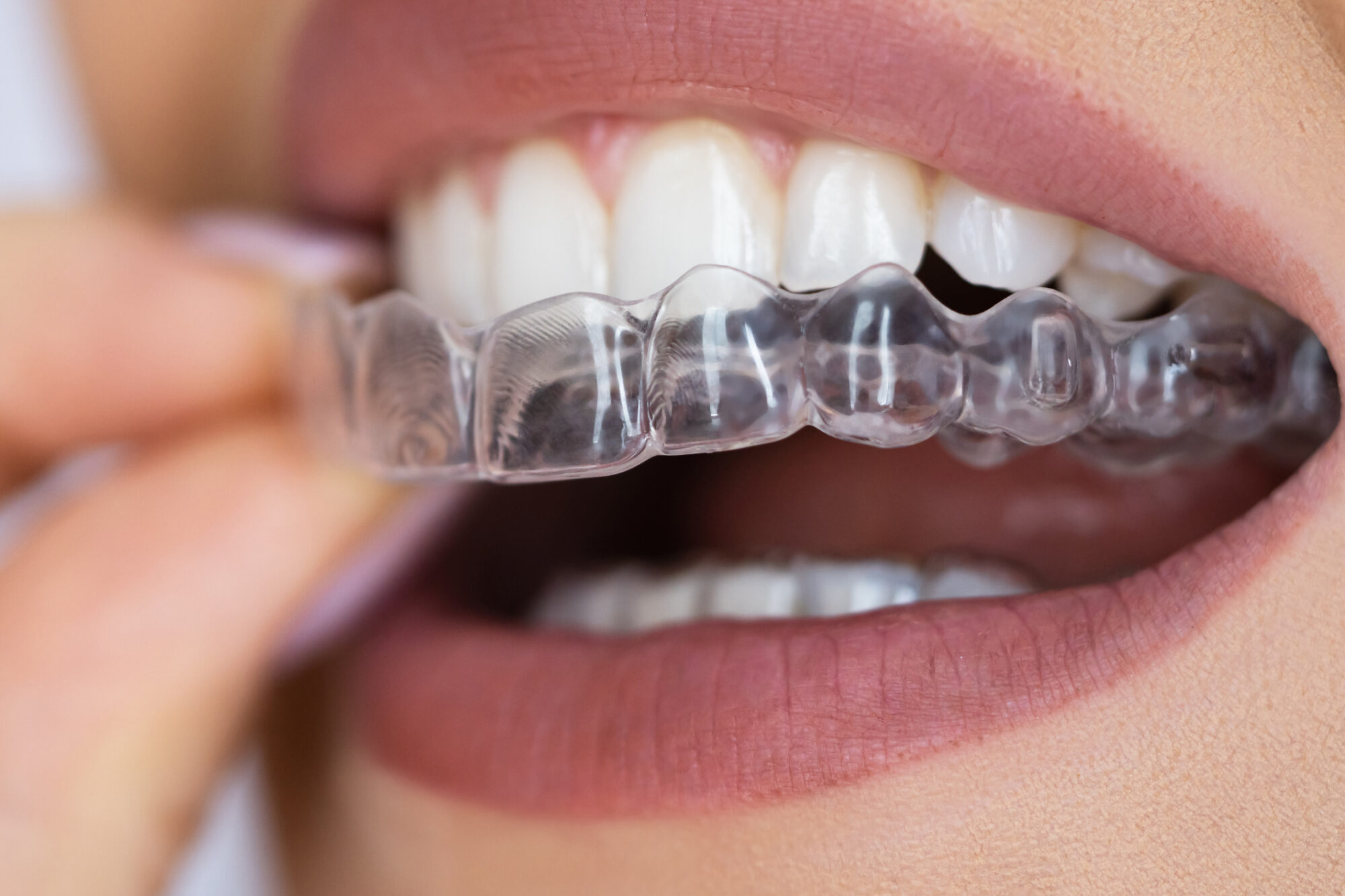 Clear Dental Aligner For Teeth